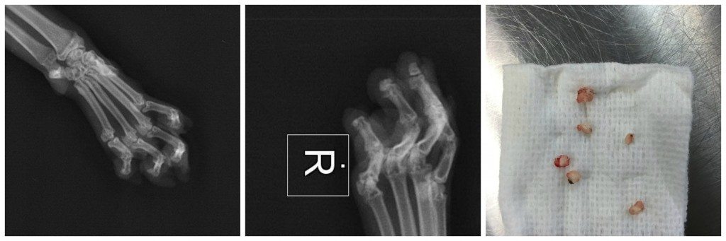 An x-ray taken before paw-repair surgery demonstrates the bony remnants seen on xray and the fragments removed after surgery. These toes, which were 'de-clawed', are riddled with scar tissue, the pads are thick, and the tendons are contracted so much that the cat has to change its gait to compensate. Paw repair surgery was performed by Montreal's Dr. Enid Stile (Sherwood Park Animal Hospital) and Dr. Gatineau (DMV) .